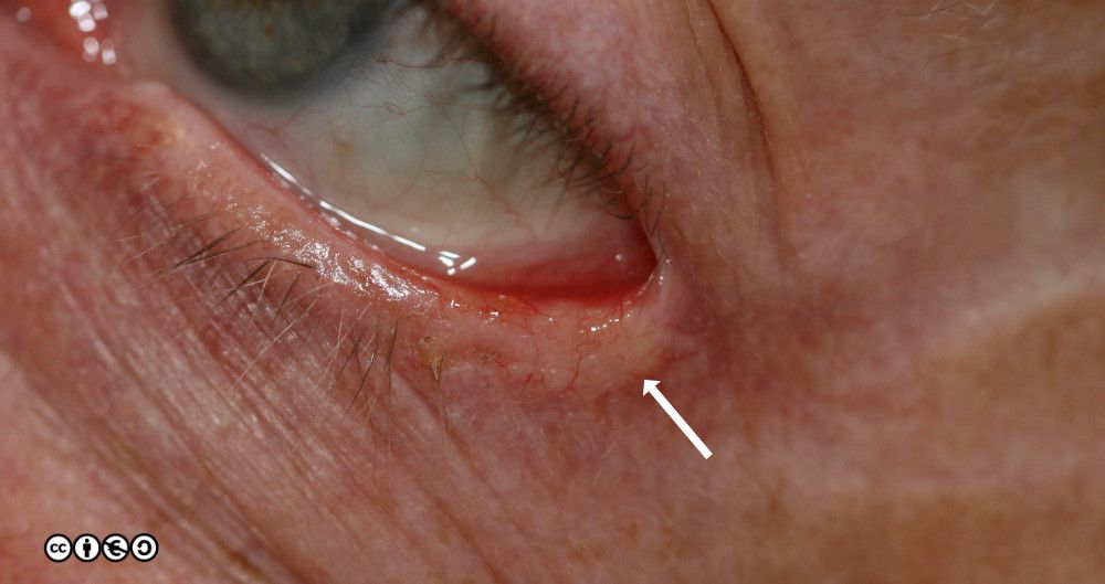 C333bH-Cfinal process EYE BCC