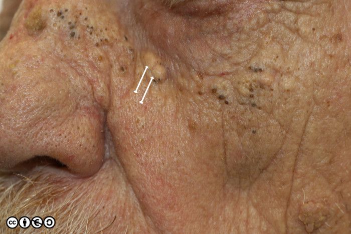 C988acuH-Cfinal POST RECT