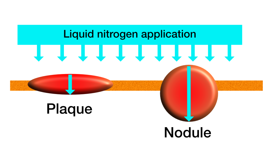 cryotherapy figure 3