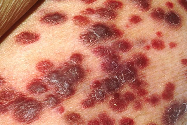 kaposi sarcoma Wikipedia
