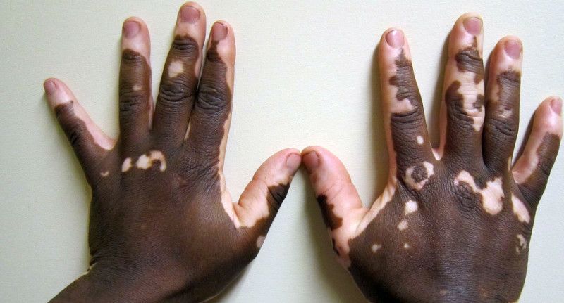 Vitiligo2 800px
