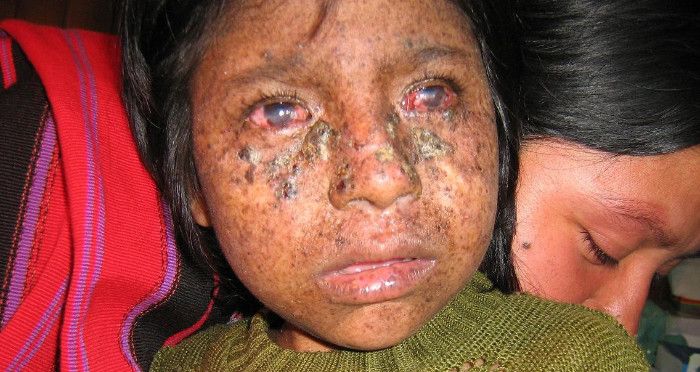 Xeroderma_pigmentosum_02 cut remix