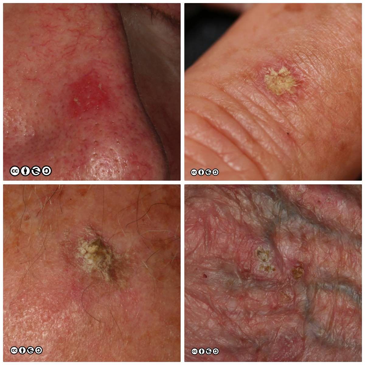 Actinic keratosis AK composite