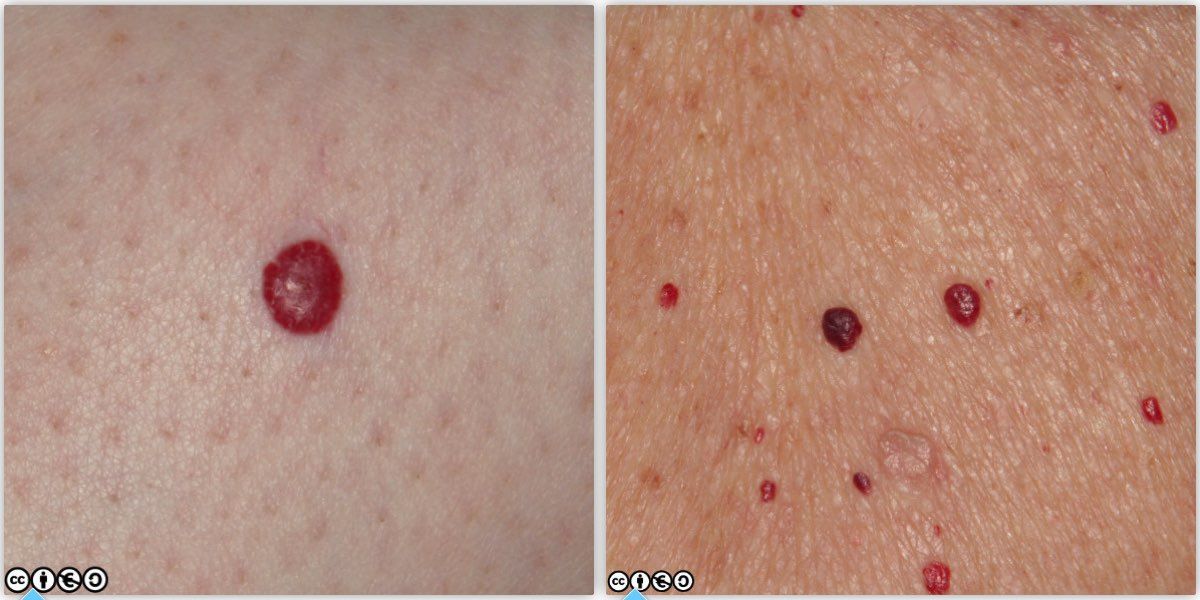 Cherry angiomas 2