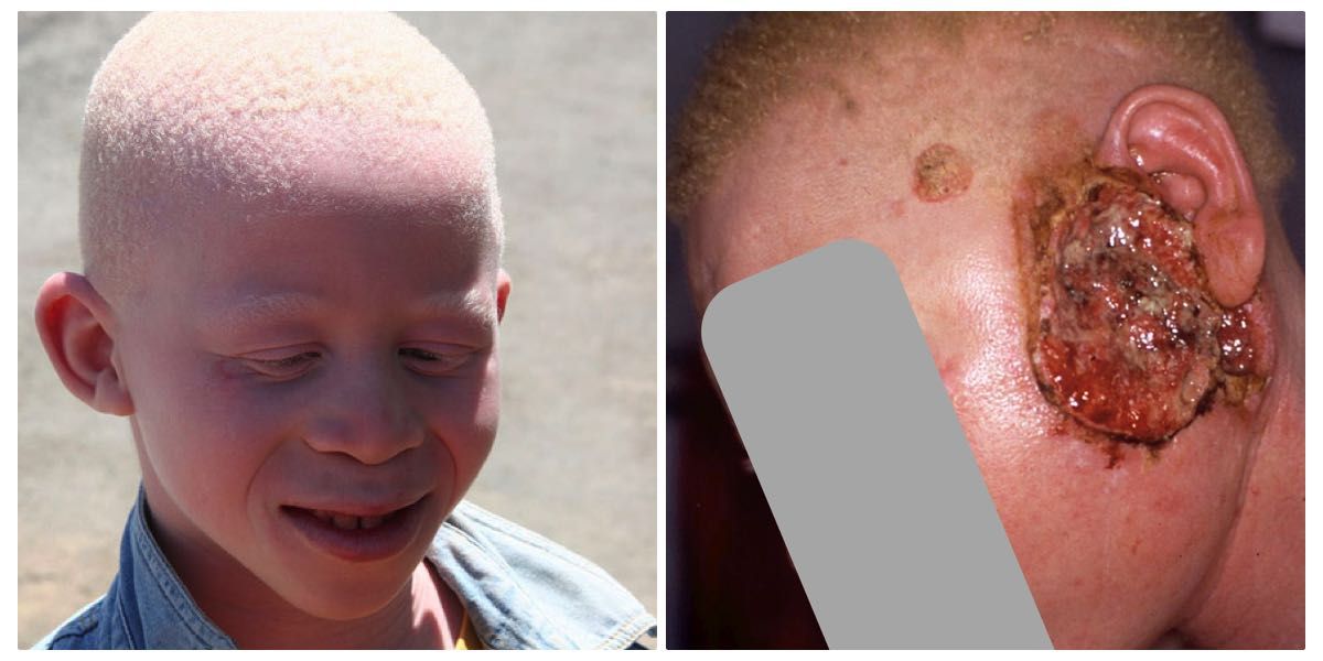 albino v2
