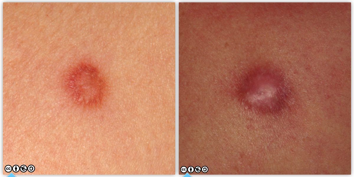 dermatofibroma pair