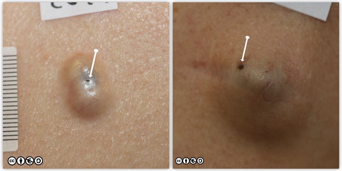 epidermal cysts