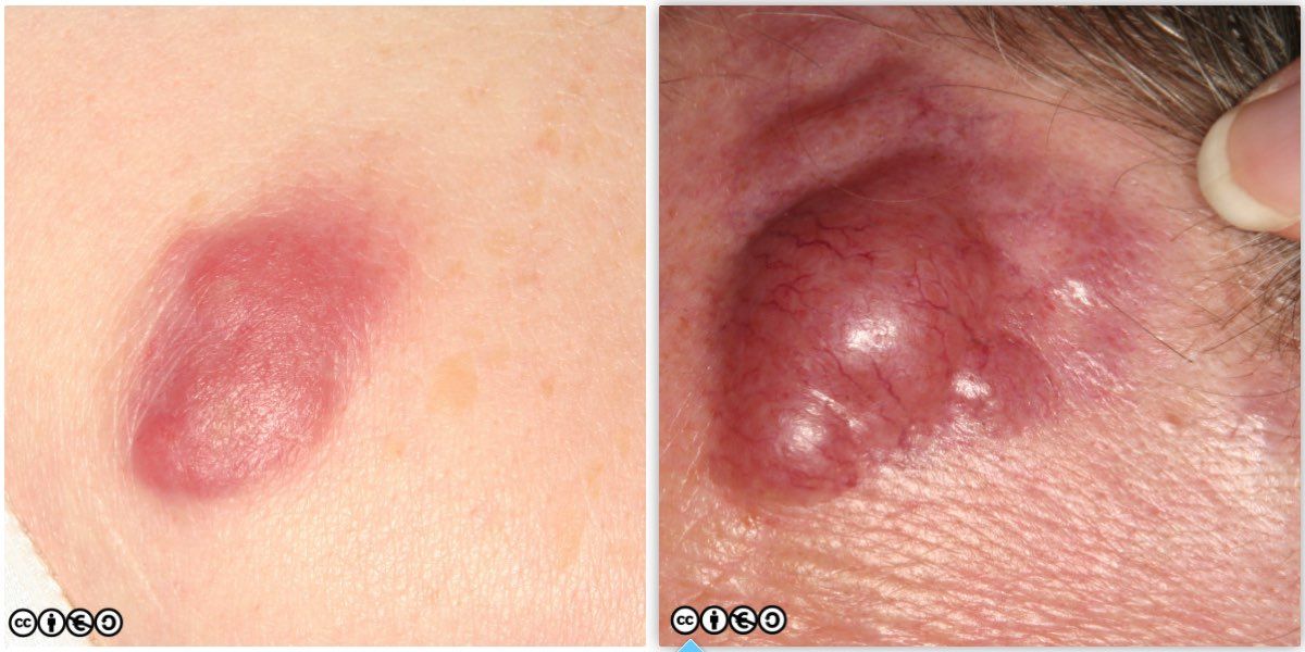 lymphoma images 2