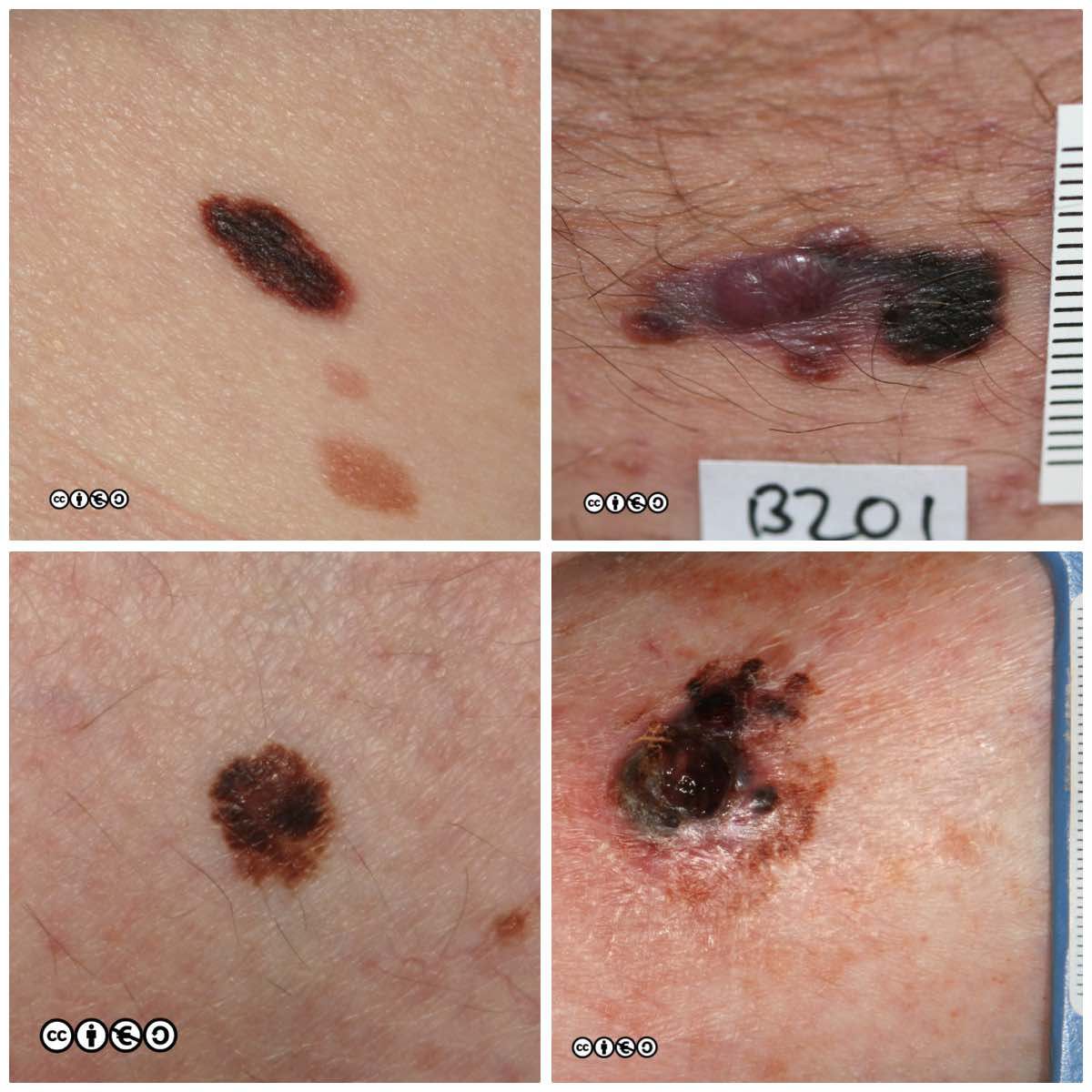 melanoma composite
