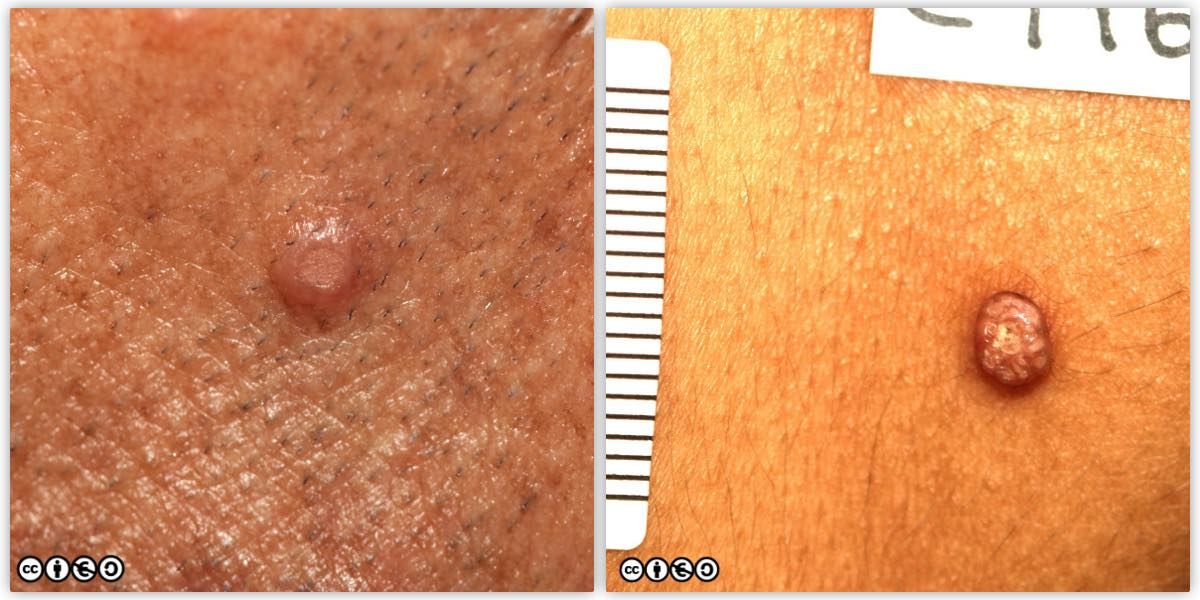 molluscum pair