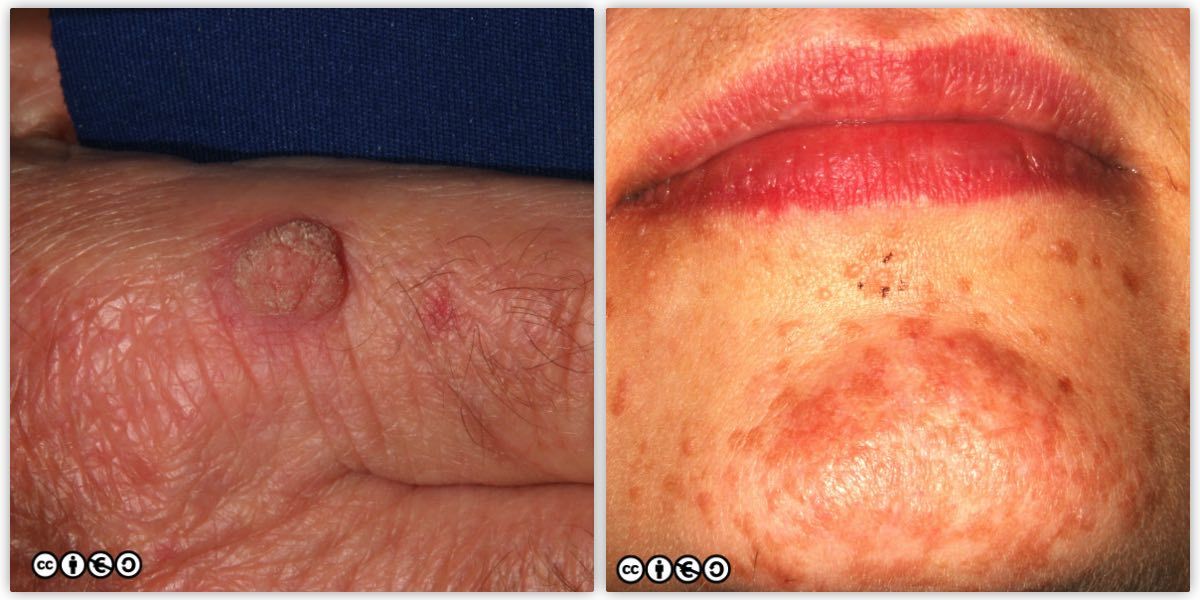 more warts pair