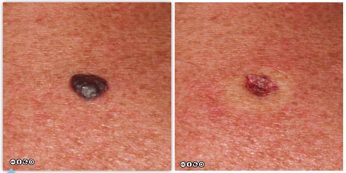 pressure on vascular