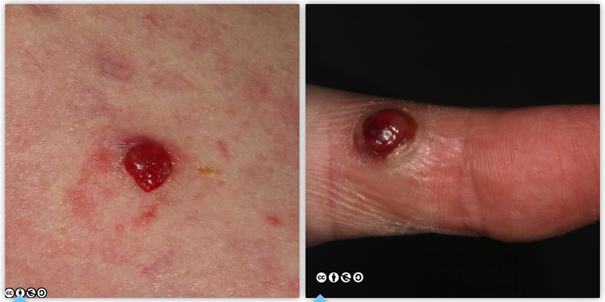 pyogenic granuloma pair