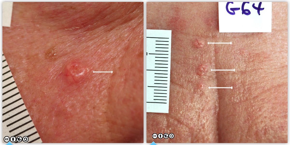 sebaceous hyperplasia pair