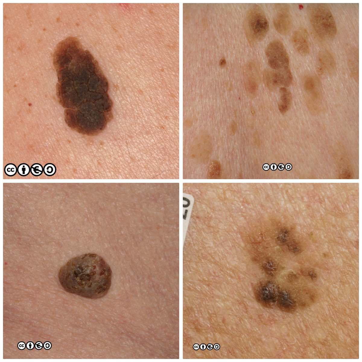 seborrhoeic keratosis composite 1
