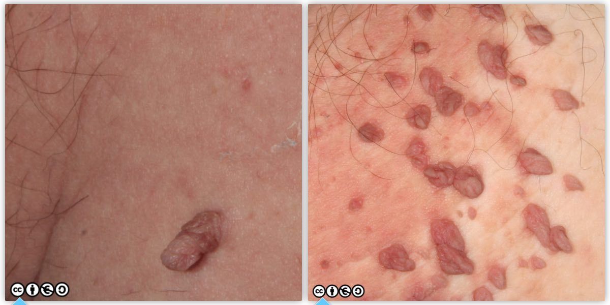 skin tags pair