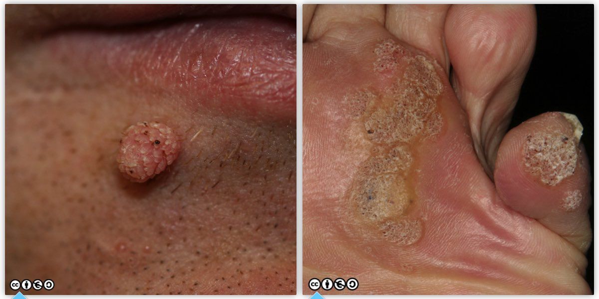 viral warts pair